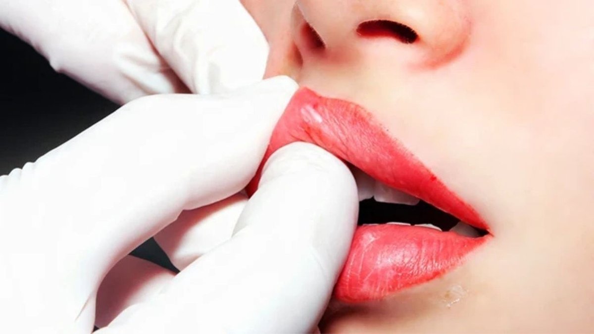 Dudak Dolgusu Yaptırmadan Önce Bilmeniz Gereken Önemli Detaylar